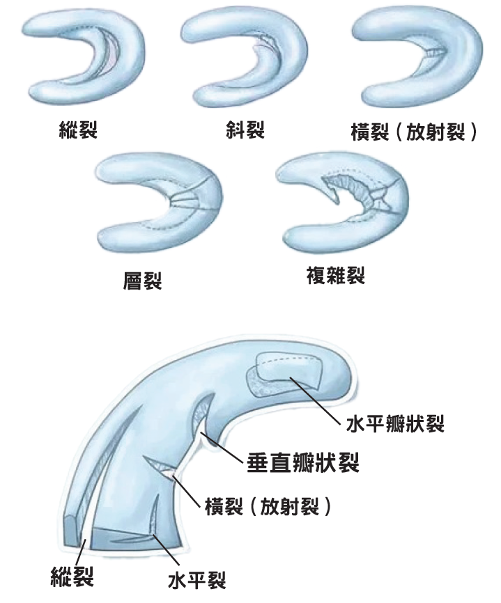 半月板撕裂